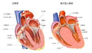 心筋肥大症