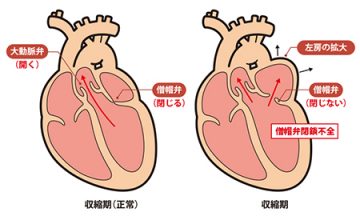 僧帽弁閉鎖不全症