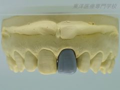 歯冠修復部門　最優秀賞　～上顎左側中切歯のワックスアップ～